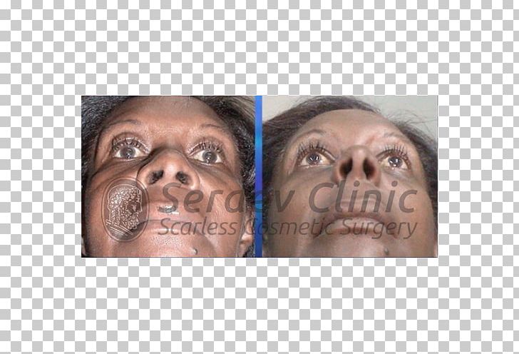 Snout Serdev Suture Surgical Suture Nose Cheek PNG, Clipart, Cheek, Chin, Ear, Eye, Eyebrow Free PNG Download