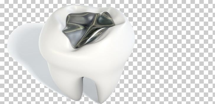 Tooth Amalgam Silver Dentistry Metal PNG, Clipart, Alloy, Amalgam, Decayed Tooth, Dentistry, Jaw Free PNG Download