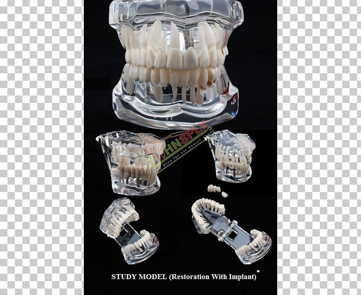 Tooth Decay Jaw Dentistry Bridge PNG, Clipart, Bridge, Dental Implant, Dentistry, Education, Glass Free PNG Download