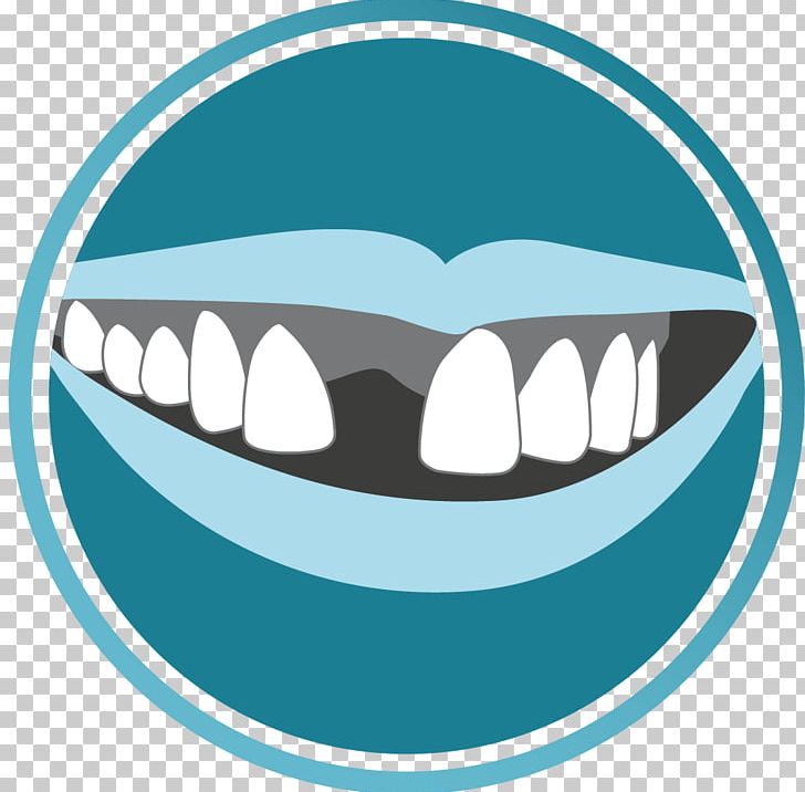 Tooth Dentistry Dental Surgery Dental Implant PNG, Clipart, Aqua, Cosmetic Dentistry, Crown, Dental Implant, Dental Surgery Free PNG Download