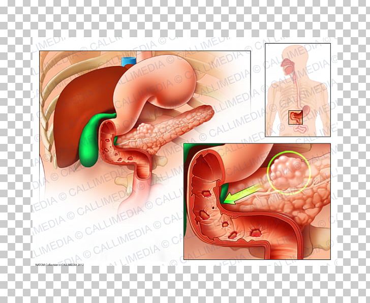 Zollinger–Ellison Syndrome Gastrinoma Peptic Ulcer Disease Symptom PNG, Clipart, Cancer, Diarrhea, Differential Diagnosis, Disease, Duodenal Ulcer Free PNG Download
