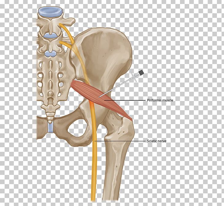 Piriformis Syndrome Piriformis Muscle Injection Surgery Sciatica PNG, Clipart, Arm, Bone, Botulinum Toxin, Buttocks, Ear Free PNG Download