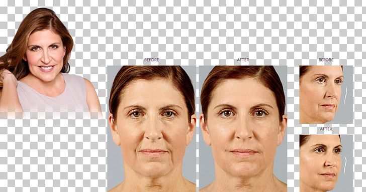 Eyebrow Injectable Filler Non-surgical Rhinoplasty Nose PNG, Clipart, Aesthetics, Cheek, Chin, Cosmetics, Doctor Of Medicine Free PNG Download