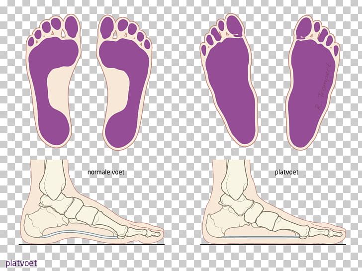 Foot Flat Feet Spreidvoet Patient Knee PNG, Clipart, Aandoening, Achilles Tendon, Balatildeo, Calcaneal Spur, Clubfoot Free PNG Download