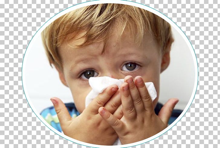 Rhinitis Hay Fever Allergy Child Rhinorrhea PNG, Clipart, Allergy, Cheek, Child, Chin, Common Cold Free PNG Download