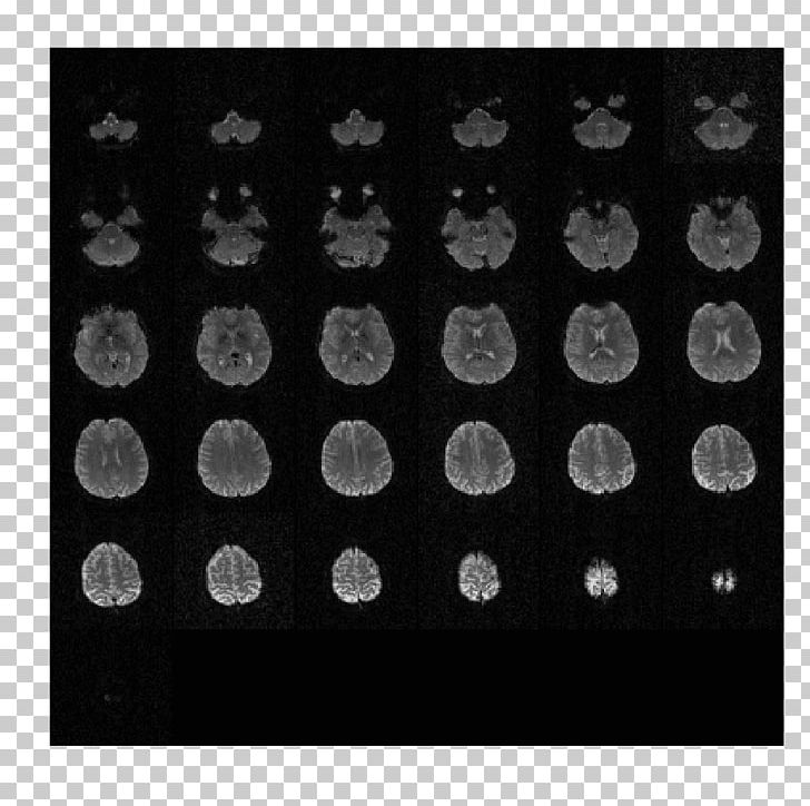 DICOM Single-photon Emission Computed Tomography Magnetic Resonance Imaging PNG, Clipart, Black, Black And White, Circle, Computed Tomography, Cran Free PNG Download