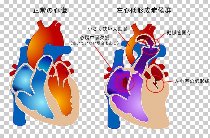 Tetralogy Of Fallot Congenital Heart Defect Blue Baby Syndrome Pentalogy Of Fallot PNG, Clipart, Birth Defect, Blue Baby Syndrome, Cardiology, Congenital Heart Defect, Cyanotic Heart Defect Free PNG Download