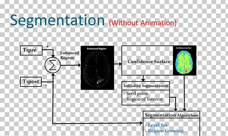Segmentation Brain Tumor Magnetic Resonance Imaging Neoplasm PNG, Clipart, Algorithm, Angle, Area, Brain, Brain Tumor Free PNG Download