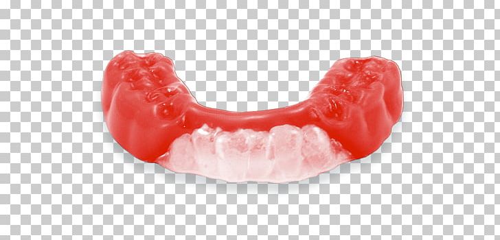 Mouthguard Tooth Athlete Sport Dentures PNG, Clipart, Athlete, Basketball, Breathing, Concussion, Custom Free PNG Download
