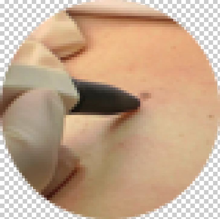 Skin Tag Wart Leicester Laser Clinic LA PNG, Clipart, Cheek, Chin, Clinic, Closeup, Cutaneous Condition Free PNG Download