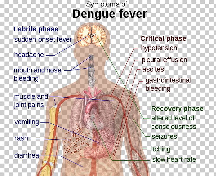 Dengue Symptomatic Treatment Fever Disease PNG, Clipart, Abdomen, Aedes Albopictus, Angle, Arm, Blood Vessel Free PNG Download