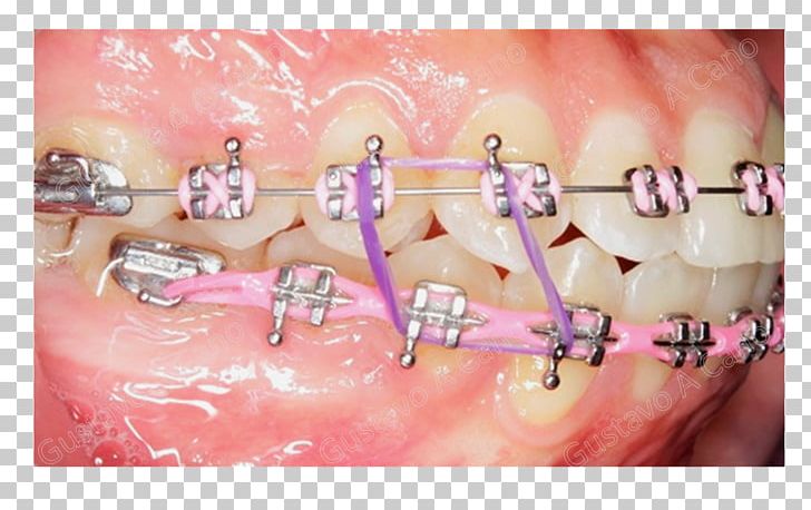 Orthodontics Dentistry Dental Braces Tooth Elasticity PNG, Clipart, Blog, Box, Cheek, Chin, Dental Braces Free PNG Download