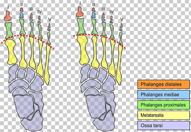 Morton's Toe Morton's Neuroma Foot Metatarsal Bones PNG, Clipart,  Free PNG Download