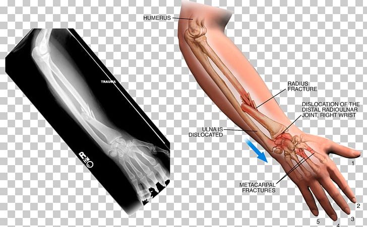 Thumb Arm Sprain X-ray PNG, Clipart, Arm, Armed, Armed Forces, Arms, Augu0161delms Free PNG Download