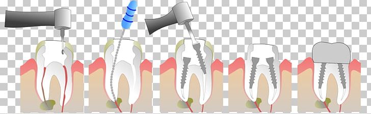 Crown Dentures Tooth Dentist Dental Implant PNG, Clipart, Bone Fracture, Bridge, Clinica Deladent, Crown, Cutlery Free PNG Download