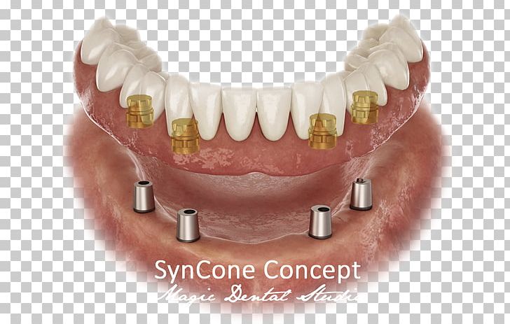 Dental Implant Dentistry Dentures Prosthesis PNG, Clipart, Abutment, Atlantis, Dental, Dental Implant, Dental Laboratory Free PNG Download