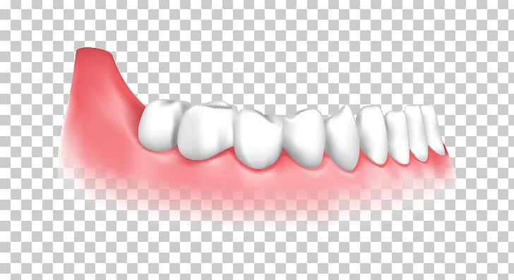 Dental Implant Dentistry Gingival Graft PNG, Clipart, Cosmetic Dentistry, Crown, Dental Implant, Dental Surgery, Dentist Free PNG Download