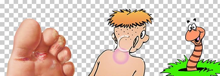 Ringworm Skin Infection Mycosis Tinea Capitis PNG, Clipart,  Free PNG Download