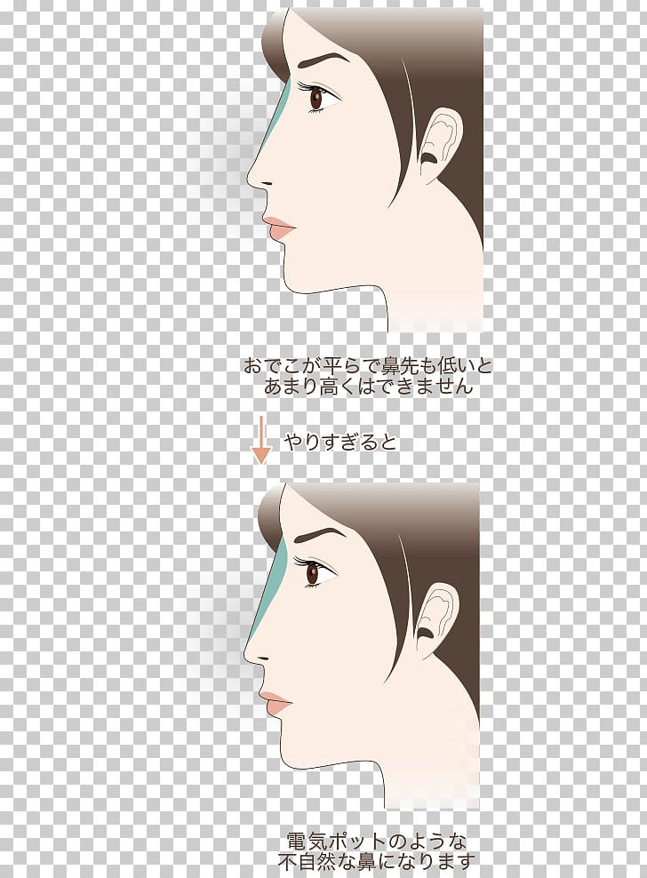 Nose Forehead Eyebrow Hyaluronic Acid 水の森美容外科 PNG, Clipart, Art, Cartoon, Cheek, Chin, Ear Free PNG Download