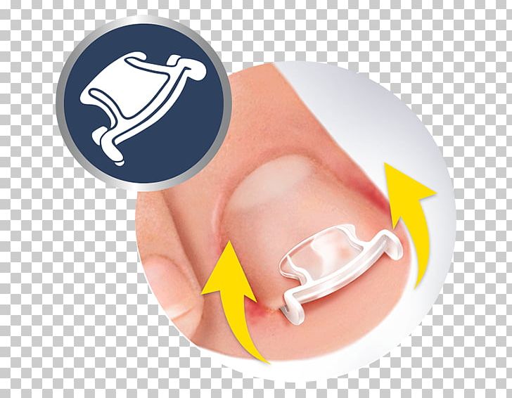 Onychocryptosis Nail Toe Dr. Scholl's Shoe PNG, Clipart, Dr Scholls, Ear, Erythema, Finger, Footwear Free PNG Download