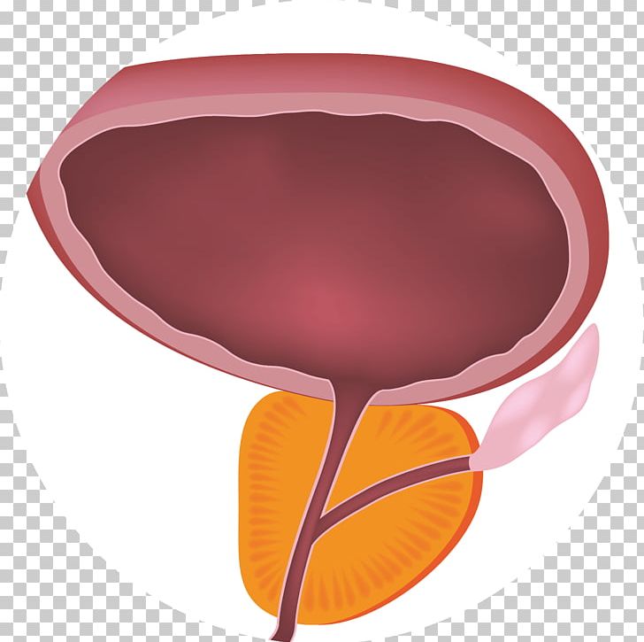 Benign Prostatic Hyperplasia Prostate Lower Urinary Tract Symptoms Benignity PNG, Clipart, Benignity, Benign Prostatic Hyperplasia, Benign Tumor, Disease, Hyperplasia Free PNG Download