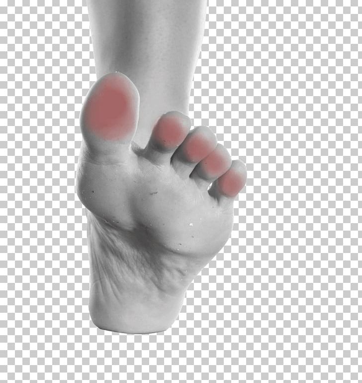 Thumb Toe Onychocryptosis Foot Nail PNG, Clipart, Ankle, Arm, Ball, Buffalo, Bunion Free PNG Download