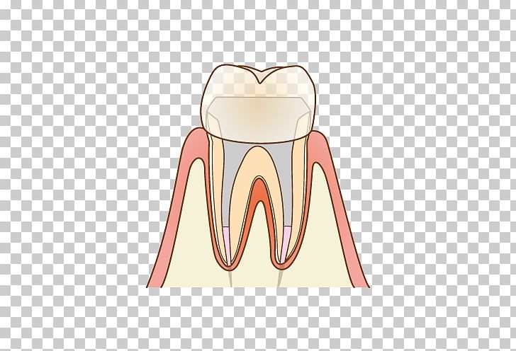 歯科 Dentist Root Canal Therapy Tooth Decay PNG, Clipart, Angle, Dental Extraction, Dentist, Ear, Endodontic Therapy Free PNG Download