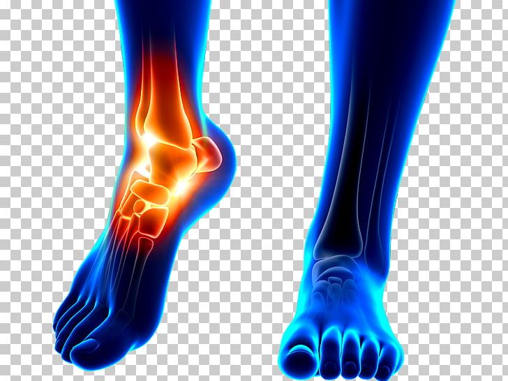 Orthopedic Surgery Sports Injury Ankle Replacement PNG, Clipart, Ankle, Ankle, Arthritis, Electric Blue, Foot Free PNG Download