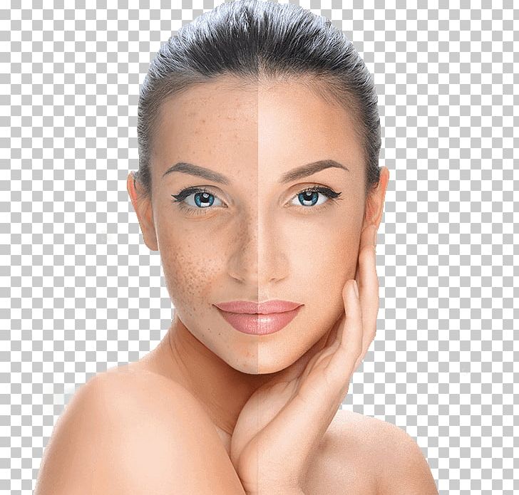 Chemical Peel Facial Skin Exfoliation Surgery PNG, Clipart, Acne, Beauty, Cheek, Chemical Peel, Chin Free PNG Download