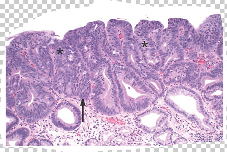 Barrett's Esophagus Intestinal Metaplasia Epithelium Adenocarcinoma PNG, Clipart, Adenocarcinoma, Epithelium, Intestinal Metaplasia, Others Free PNG Download