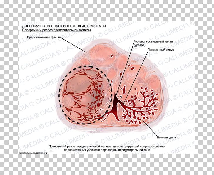 Prostate Cancer Benign Prostatic Hyperplasia Hypertrophy Benign Tumor PNG, Clipart, Benign Prostatic Hyperplasia, Gland, Hyperplasia, Hypertrophy, Miscellaneous Free PNG Download