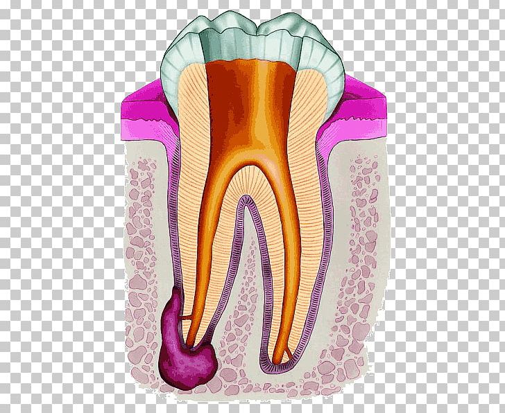 Endodontic Therapy Root Canal Endodontics Dentistry PNG, Clipart, Crown, Dental Restoration, Dental Surgery, Dentist, Dentistry Free PNG Download