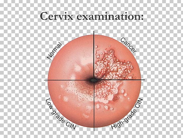 cervical papilomavirus uman