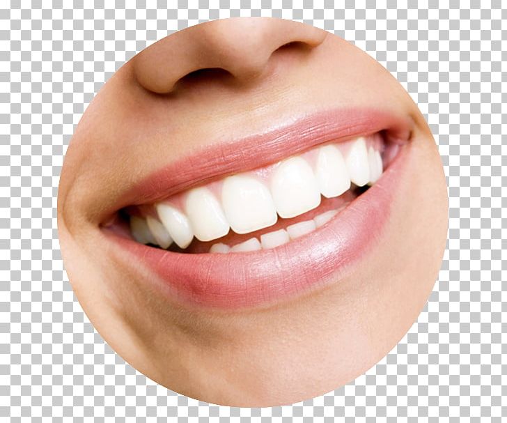 Tooth Whitening Cosmetic Dentistry Human Tooth PNG, Clipart, Bridge, Chin, Closeup, Cosmetic Dentistry, Crown Free PNG Download