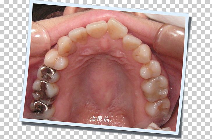 Nail Human Tooth PNG, Clipart, Cheek, Dentistry, Finger, Human Tooth, Jaw Free PNG Download