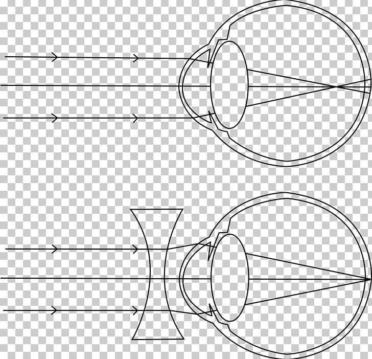 Near-sightedness Light Myopia And Hyperopia (Nearsightedness And Farsightedness) Visual Perception Presbyopia PNG, Clipart, Angle, Area, Artwork, Black And White, Cataract Free PNG Download