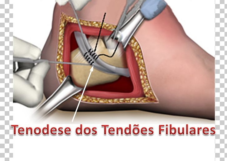 Tendon Thumb Peroneus Brevis Peroneus Longus Foot Tubular Hand Foot