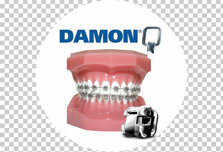 Damon System Dental Braces Orthodontics Self-ligating Bracket Dentistry PNG, Clipart, Clear Aligners, Damon System, Dental Braces, Dental Implant, Dentistry Free PNG Download