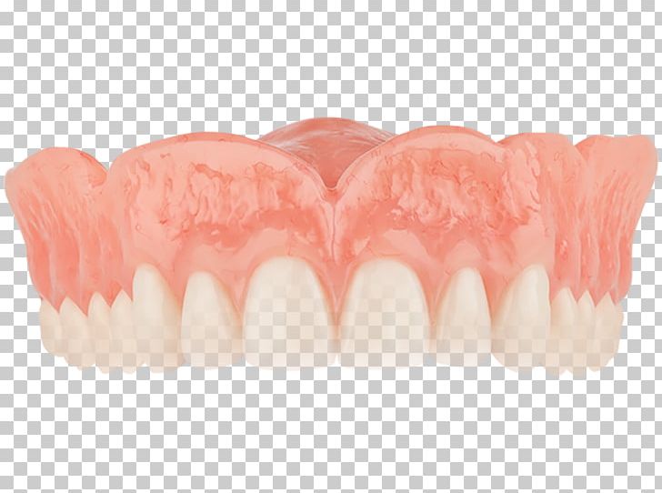 Dentures Tooth Dentistry Removable Partial Denture PNG, Clipart, Aspen Dental, Crown, Dental Implant, Dentist, Dentistry Free PNG Download
