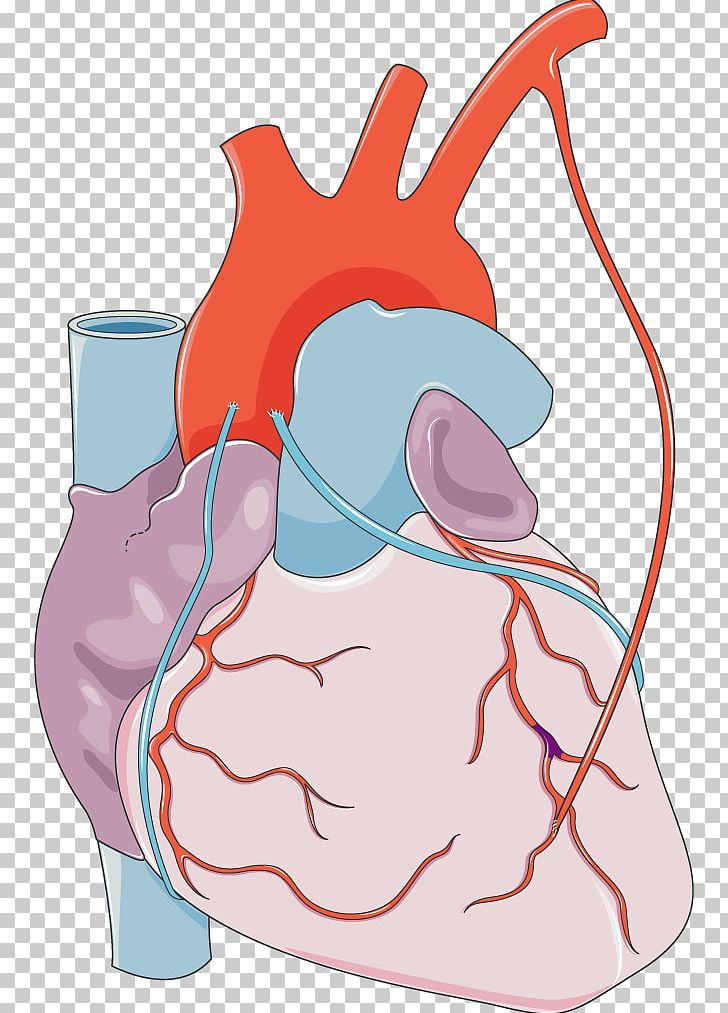 Myocardial Infarction Heart Monocyte Coronary Artery Disease Medical PNG, Clipart,  Free PNG Download