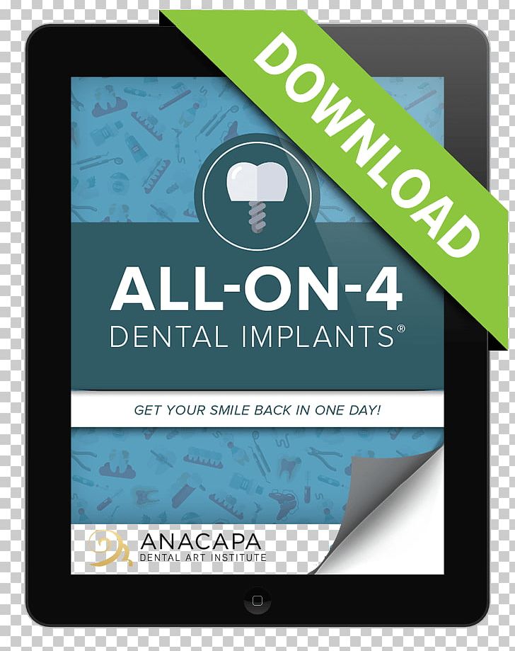 All-on-4 Dental Implant Dentist Tooth Bellevue Dental Care & Implant Center PNG, Clipart, Allon4, Blue, Brand, Dental Implant, Dental Implants Free PNG Download