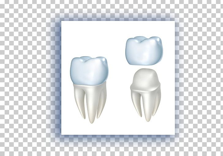 Crown Dentistry Dental Restoration Dental Implant PNG, Clipart, Bridge, Cadcam Dentistry, Cosmetic Dentistry, Crown, Damaged Tooth Free PNG Download