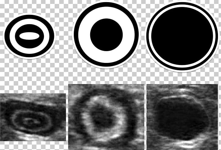 Abdominal Ultrasonography Appendicitis Emergency Medicine Intestine PNG, Clipart, Abdomen, Abdominal Ultrasonography, Appendicitis, Appendix, Black And White Free PNG Download