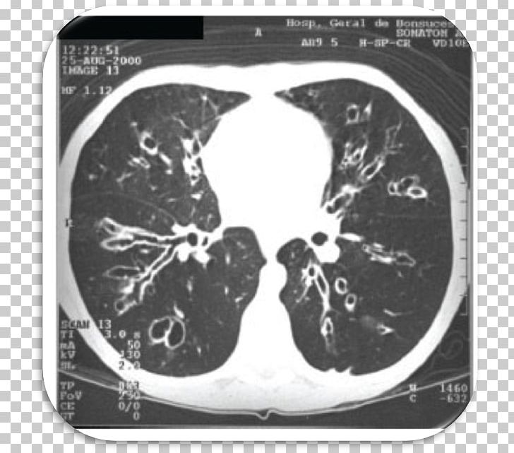 Computed Tomography Radiology Cystic Fibrosis Bronchiectasis PNG, Clipart, Aspergillus, Atelectasis, Autosome, Black And White, Bronchiectasis Free PNG Download