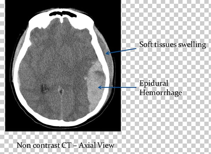 Computed Tomography Of The Head Brain Epidural Hematoma Cerebral Hemorrhage PNG, Clipart, Angle, Bleeding, Brain, Brain Herniation, Circle Free PNG Download