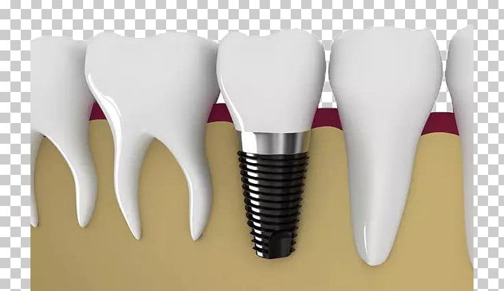 Dental Implant Dentistry Tooth Veneer Dental Restoration PNG, Clipart, Background White, Black White, Bone, Bone Grafting, Dental Braces Free PNG Download
