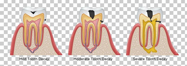 Tooth Decay Human Tooth Dentistry Dental Restoration PNG, Clipart, Ache, Cause, Dental Caries, Dental Composite, Dental Restoration Free PNG Download