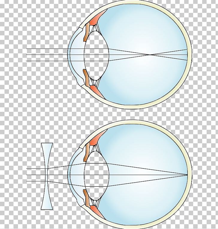 Near-sightedness Hypermetropia Corrective Lens Refractive Error PNG, Clipart, Angle, Area, Astigmatism, Circle, Contact Lenses Free PNG Download