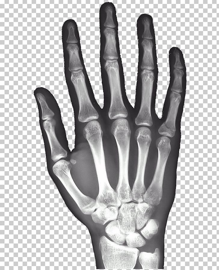 X-ray Hand Carpal Bones Android PNG, Clipart, Android, Black And White, Bone, Bone Age, Carpal Bones Free PNG Download