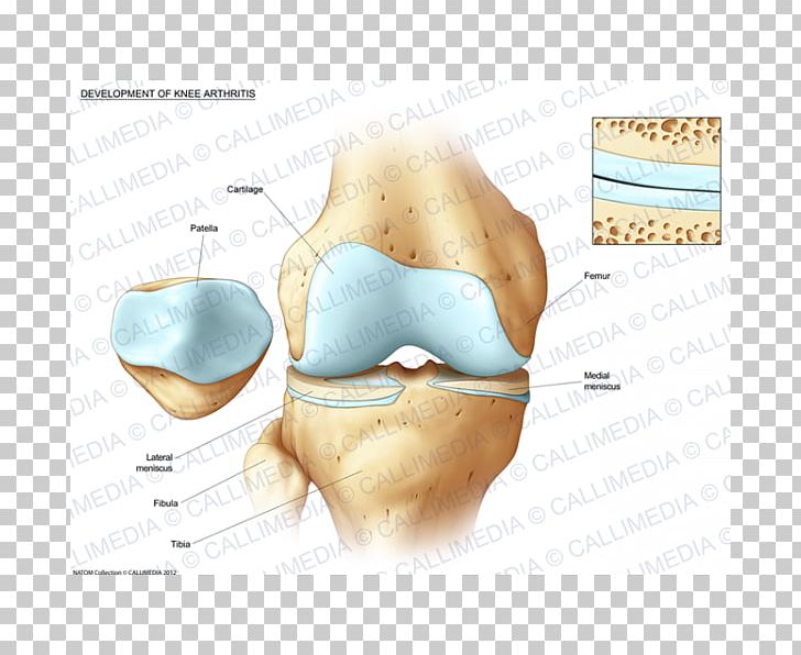Knee Bone Fracture Tibia Pathology PNG, Clipart, Bone, Bone Fracture, Disease, Ear, Femur Free PNG Download